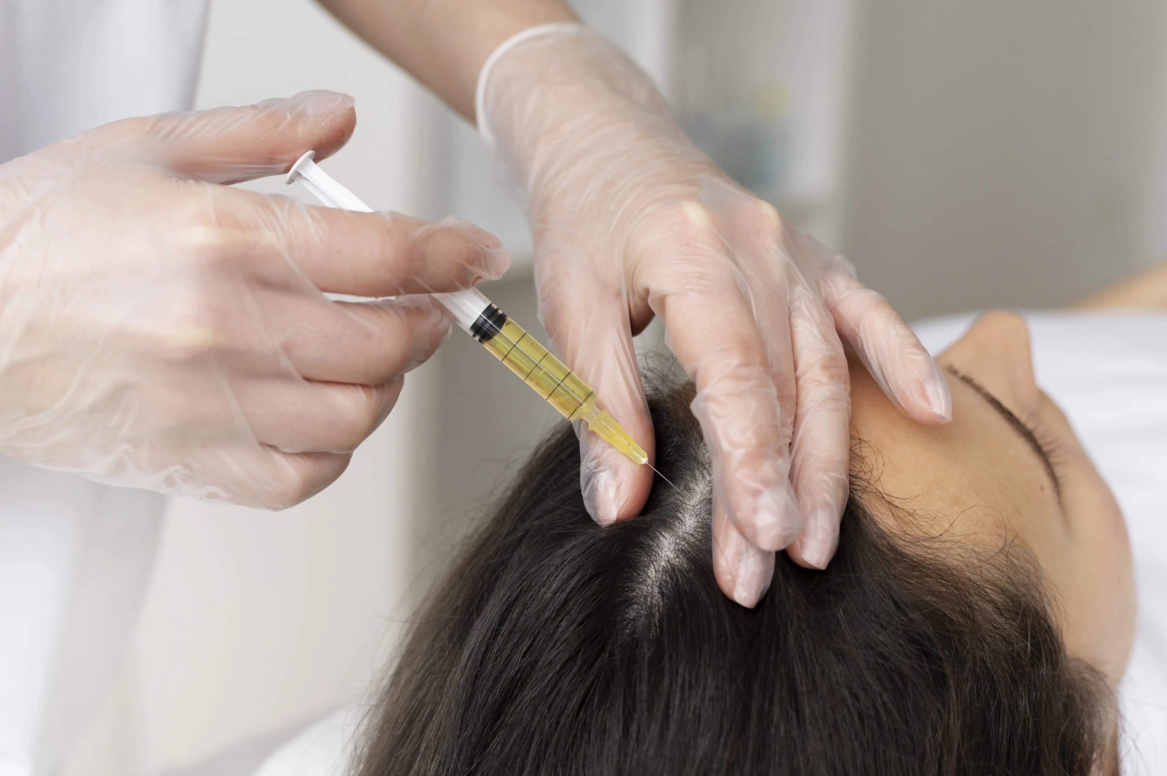 PRP Hair Treatment in Noida