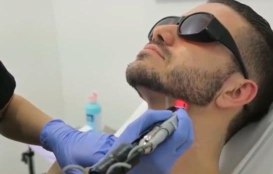 Laser Toning Facial for Men