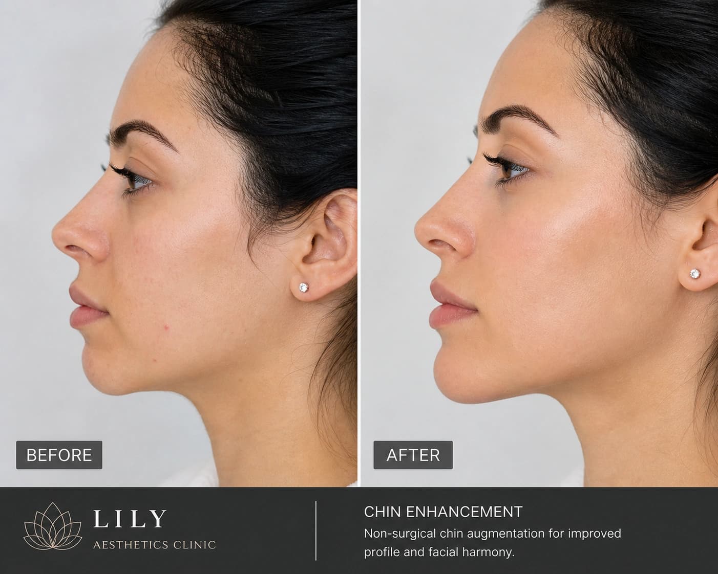 Chin Enhancement For Women