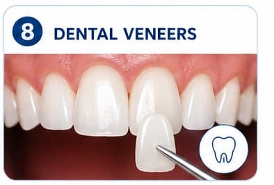 Dental Veneers
