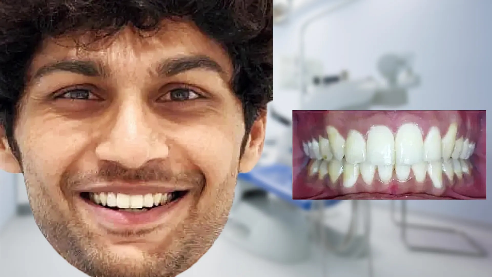 Teeth aligner