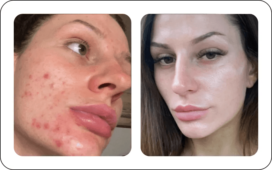 Acne Arrestor Facial with Salicylic Peel