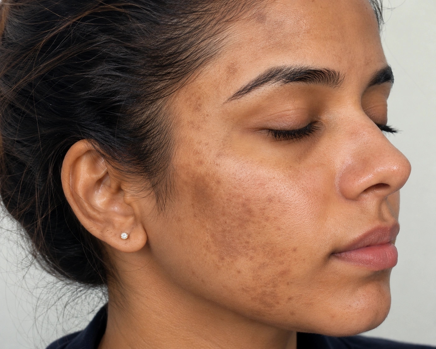 Pigmentation 