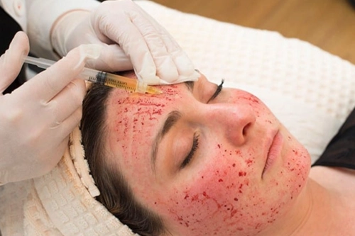 Vampire Facial vs PRP: What’s the Difference?