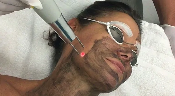Is Carbon Laser Facial Safe for All Skin Types?