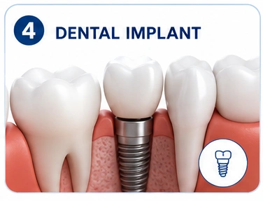 Dental Implant