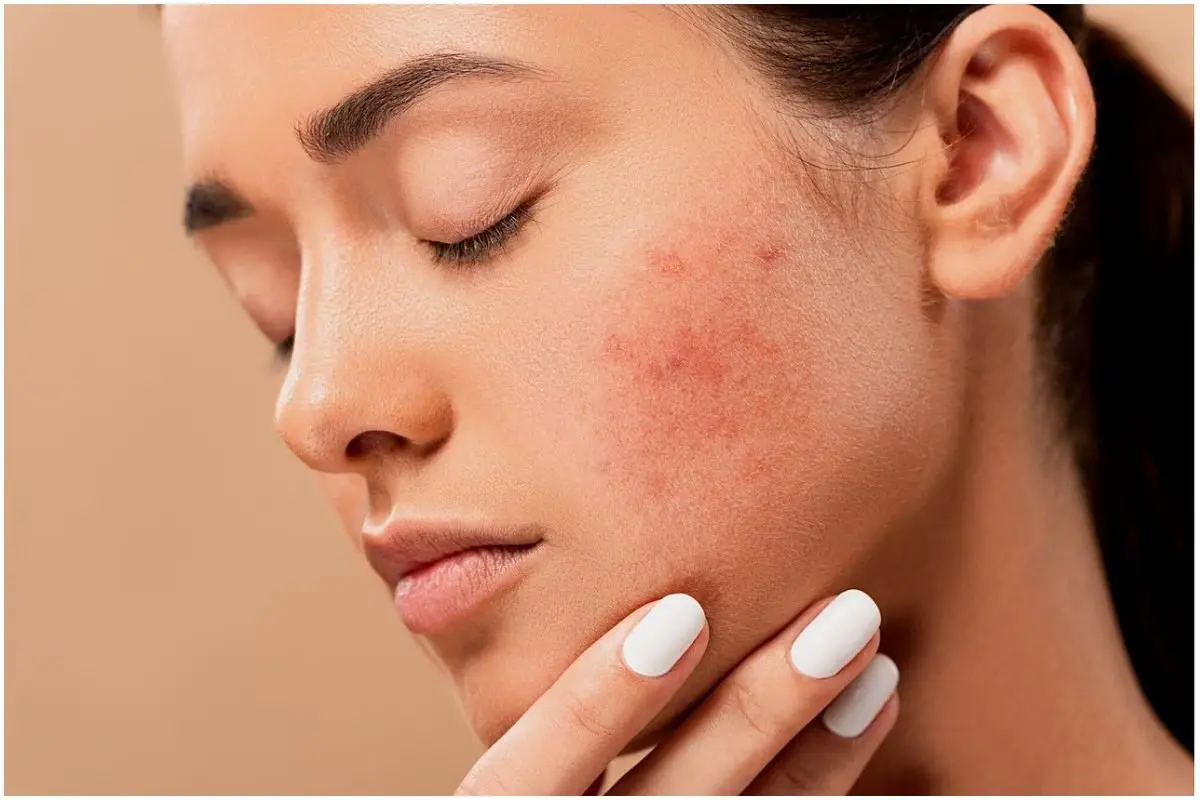 5 Summer Skincare Mistakes That Are Worsening Your Acne