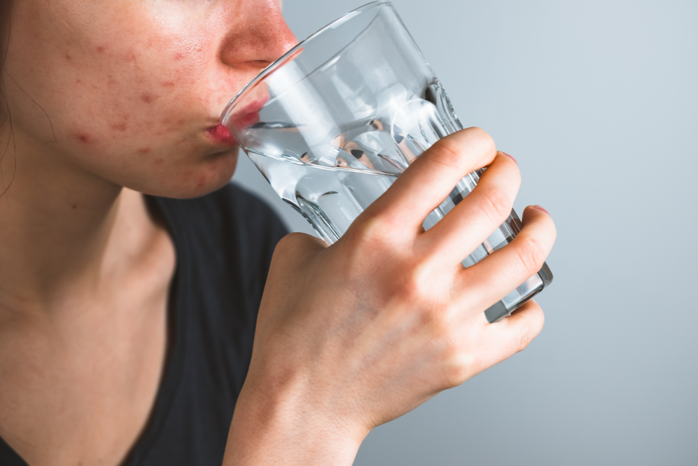 Does Drinking Water Really Help With Acne? We Asked a Dermatologist