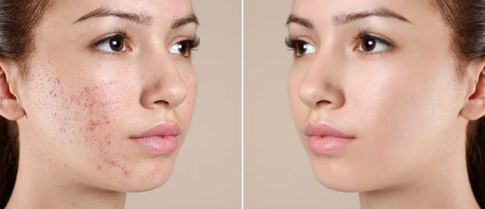 Home Remedy vs Clinical Treatment for Acne: Honest Comparison
