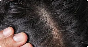 Dandruff and Scalp Health: How They Are Linked to Hair Fall