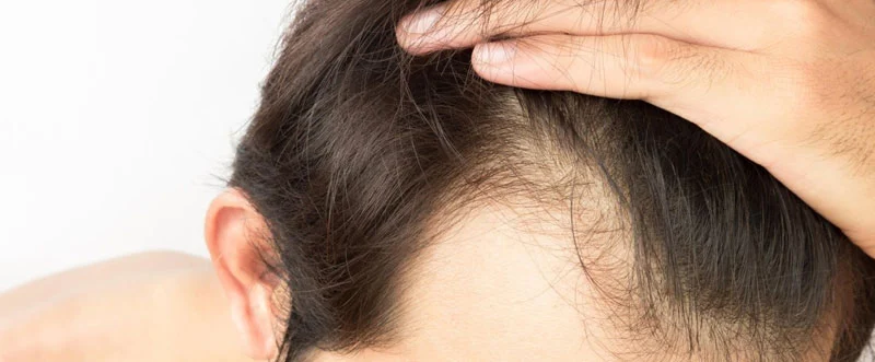 Hair Fall Treatment in Ghaziabad: Medical Treatment at Siama