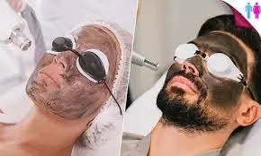 Carbon Laser Facial for Men vs Women: Are They Different?