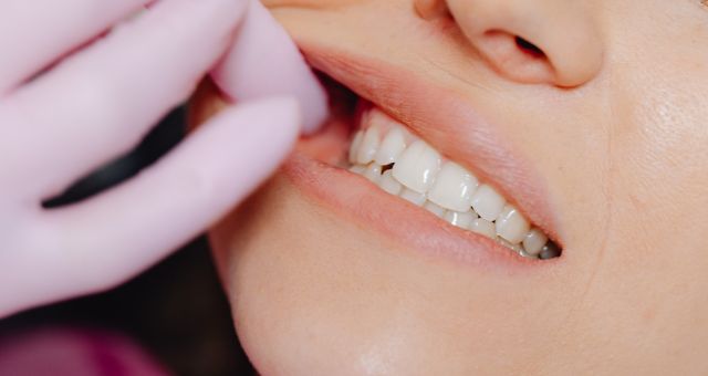 Teeth Fillings