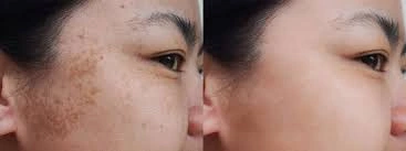 Q-Switch Laser for Pigmentation: How Many Sessions Are Needed and What Results Can You Expect?