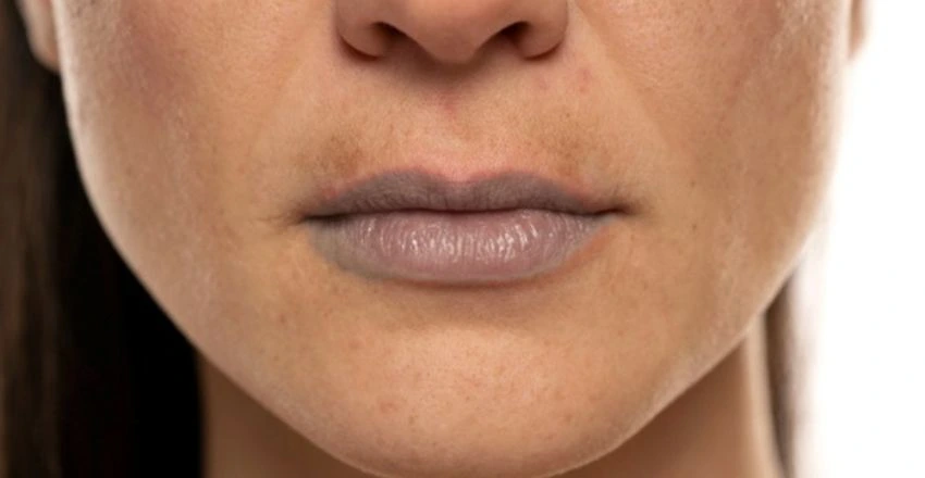 Pigmentation Treatment in Noida: Clinical Options and Cost