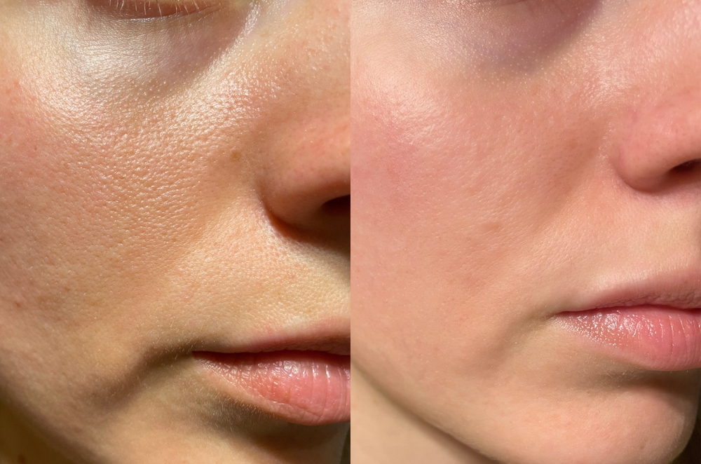 RF Microneedling vs Laser Skin Tightening: Which Is Right for You?