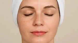 HydraFacial for Anti-Ageing: Is It Worth It After 35?